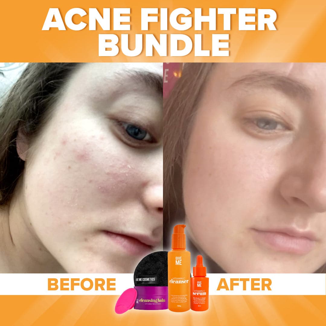 The Acne Fighter Bundle - Give Me Cosmetics